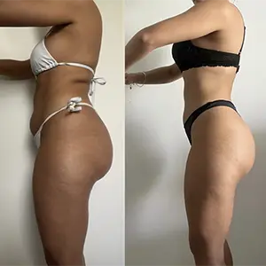 Resultado Lymphoderm