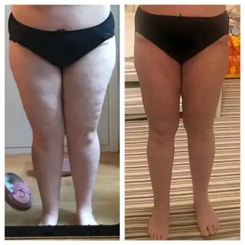 Resultado Lymphoderm